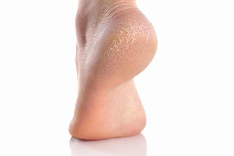 Потрескавшиеся пятки