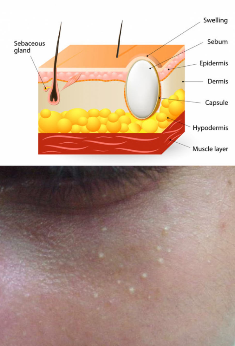 Прыщи комедоны угри акне