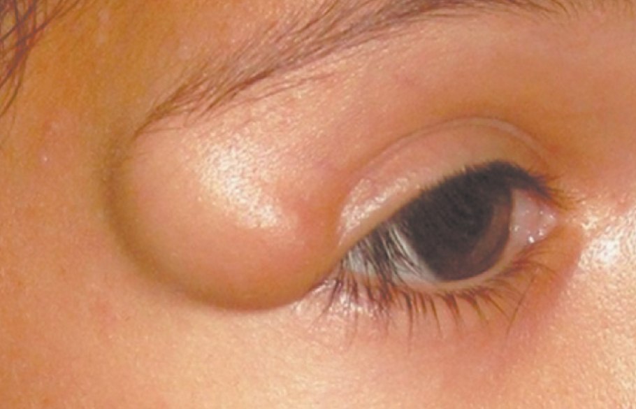 Атерома киста сальной железы