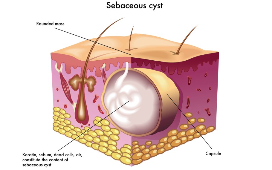Катаральный афтозный стоматит