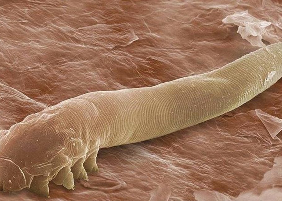 Инфракрасная коагуляция геморроя