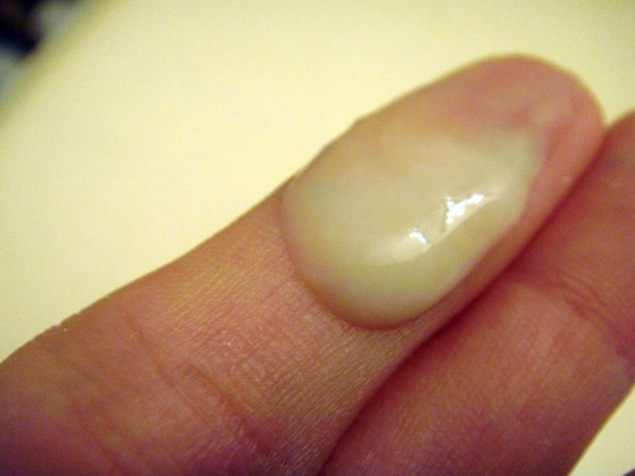 Стафилококковый везикулопустулез