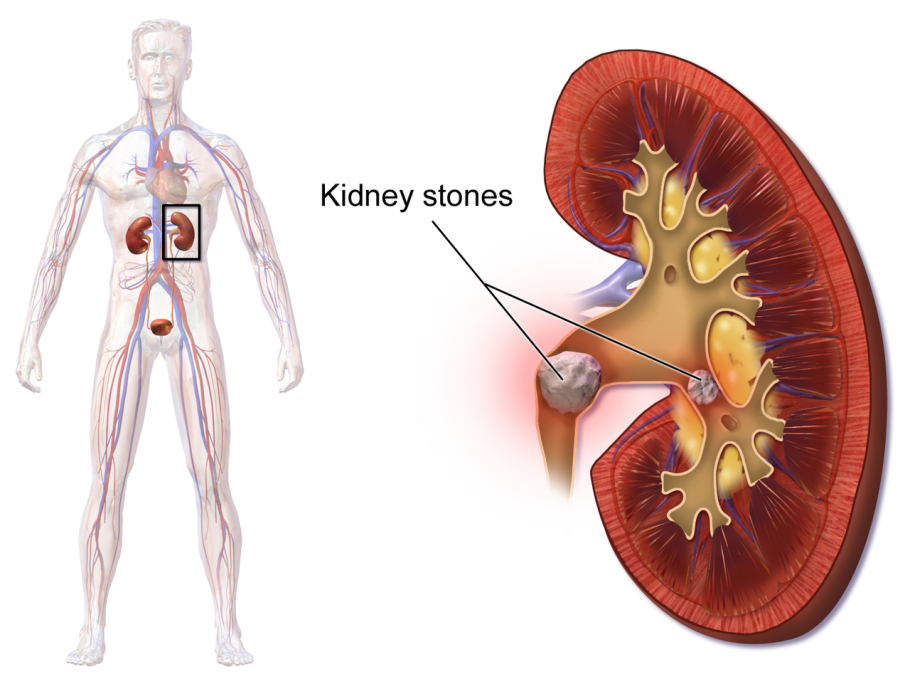 Kidney stone