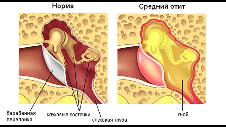 Острый Гнойный средний отит барабанная перепонка