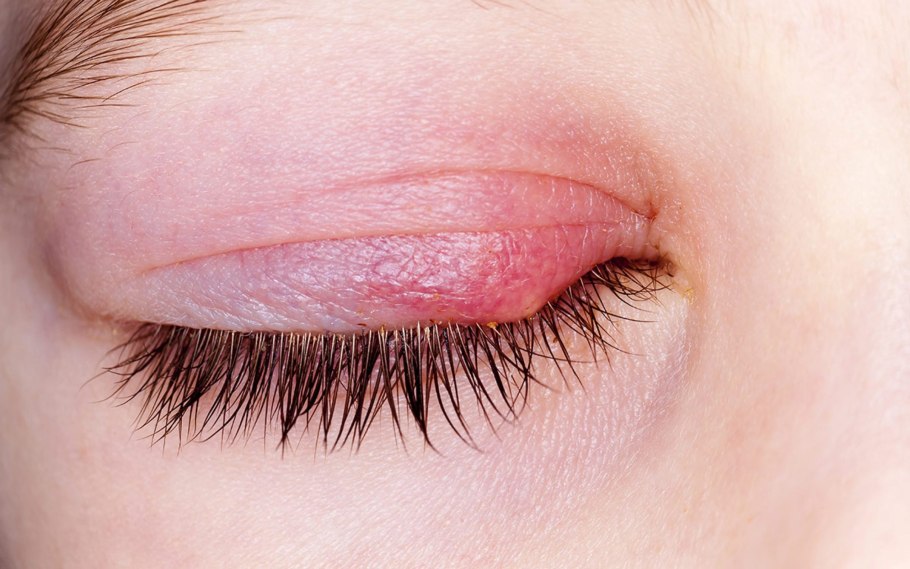 Фраксель лазерная терапия кожи