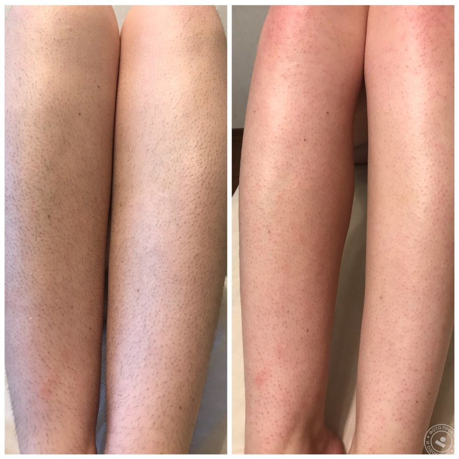 Депиляция ног до и после