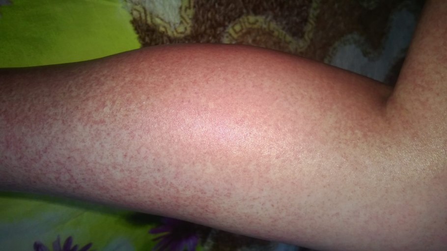 Крапива двудомная шипы