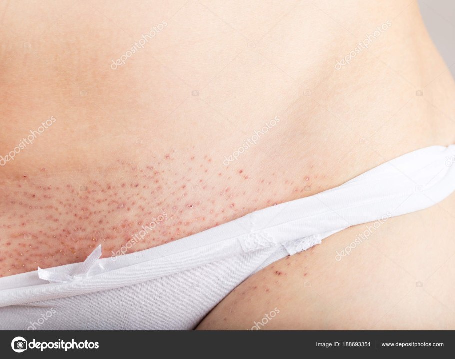 Крапива стрекательные