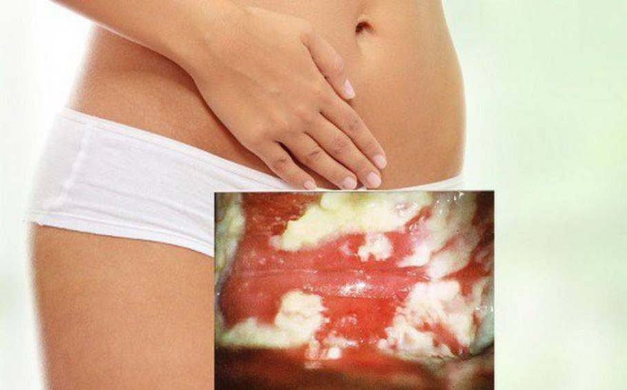 Кусачая крапива