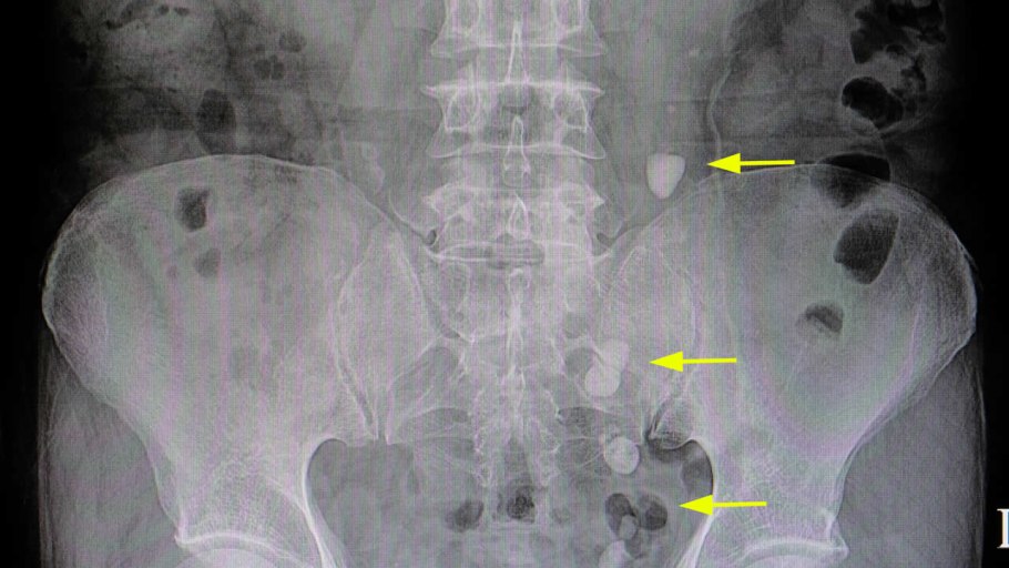 Ежовик коралловидный
