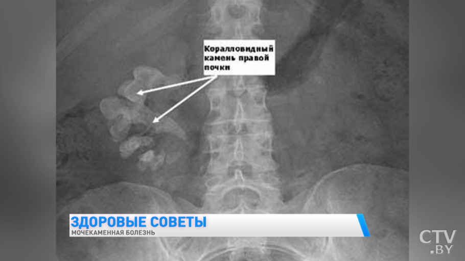 Известковые камни в желчном пузыре