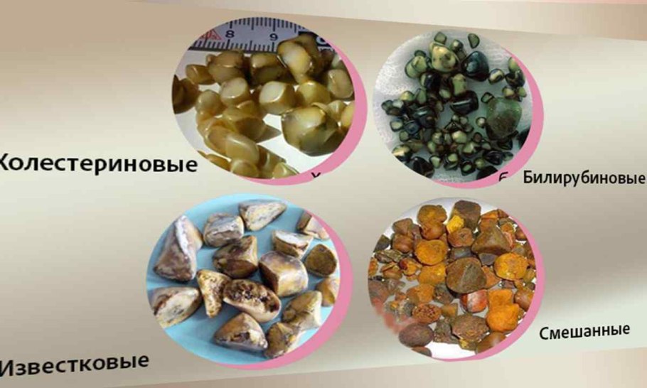 Коралловидный камень в почке