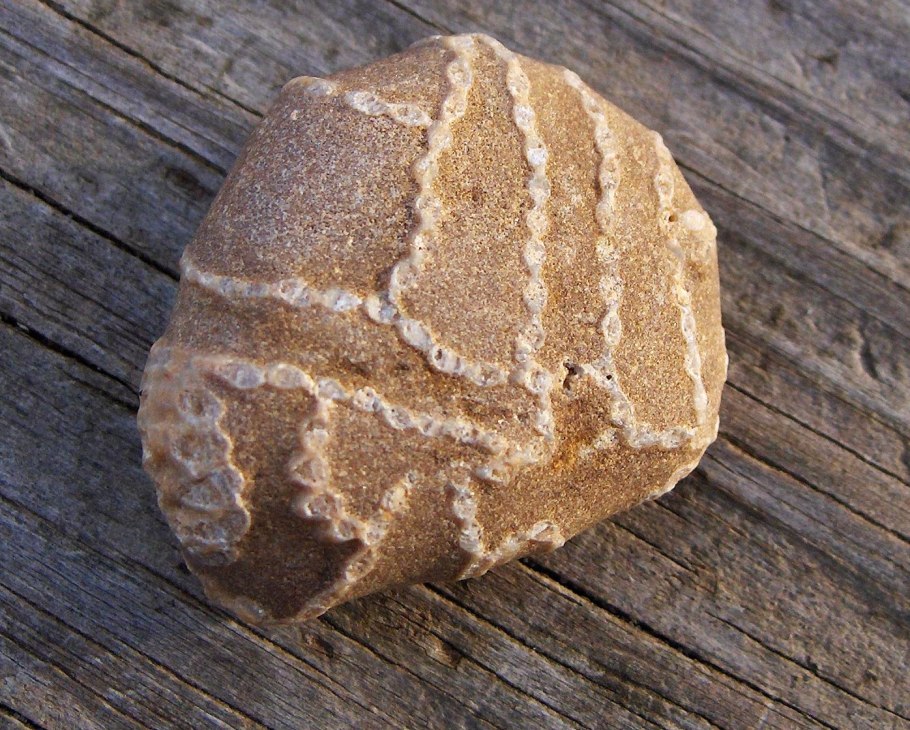 Самые большие камни в почках