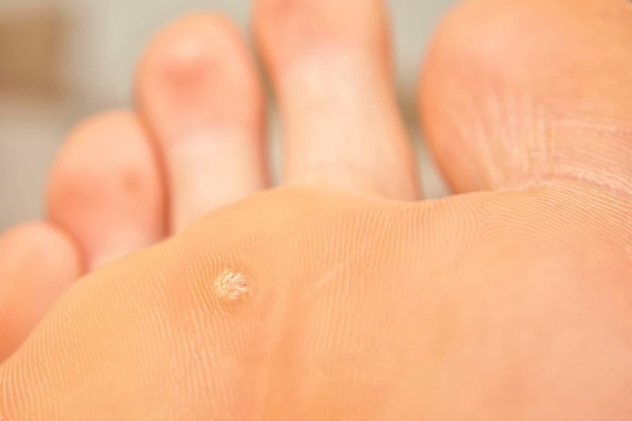 Подошвенная бородавка шипица