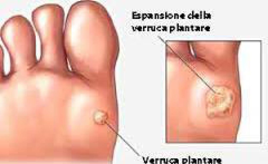 Кондиломы контагиозный моллюск
