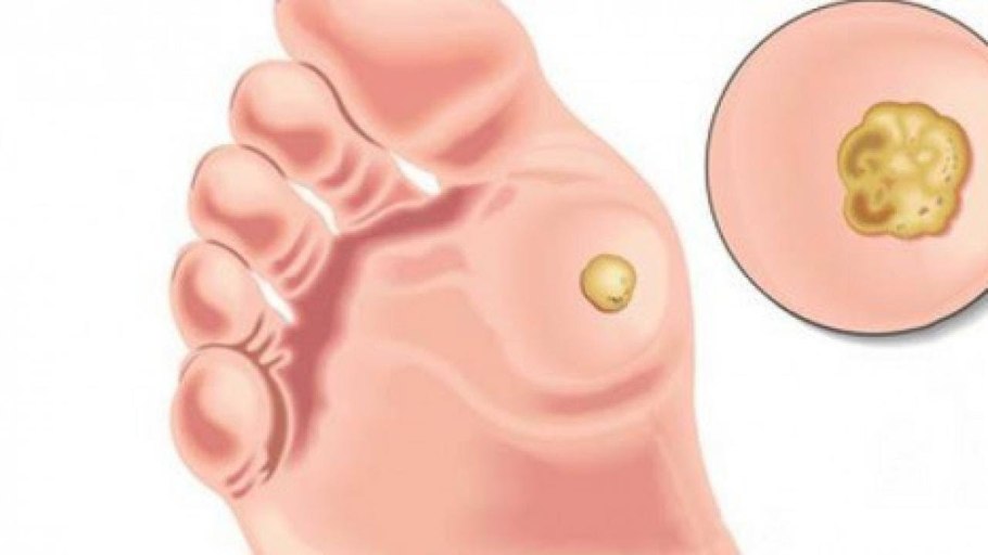 Маленькие бородавки на пальце