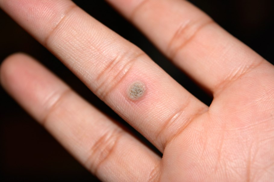 Бородавки шипицы на руках