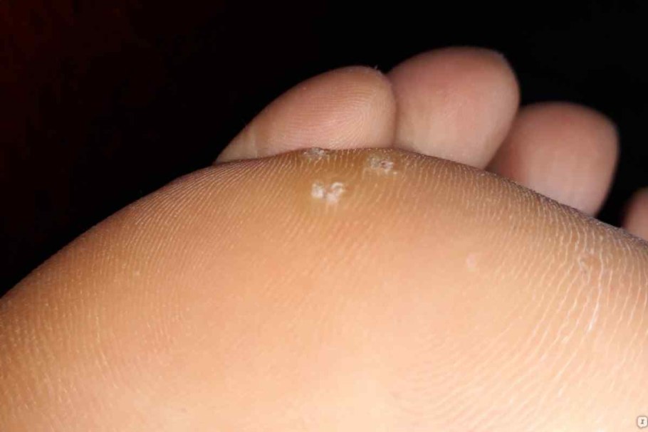 Злокачественная ангиома