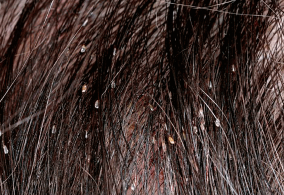 Кератопапиллома меланома