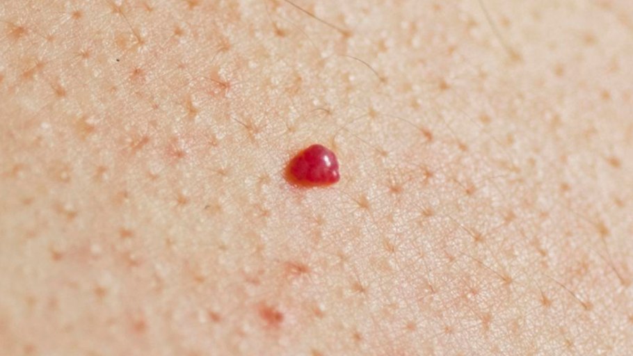 Папиллома доброкачественная опухоль