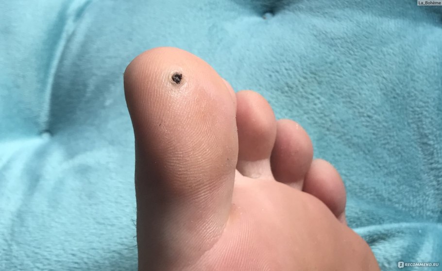 Дерматофиброма дерматоскопия