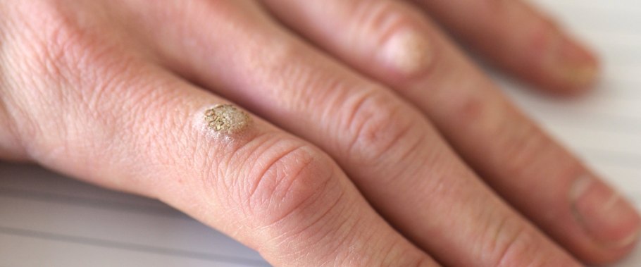 Подошвенные бородавки-шипицы.