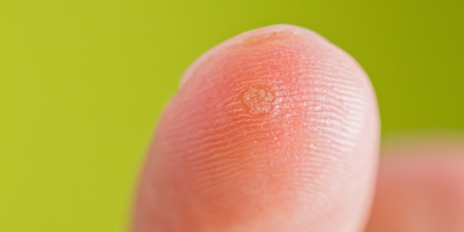 Корни шипицы бородавки