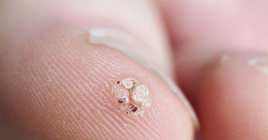 Подошвенная бородавка шипица