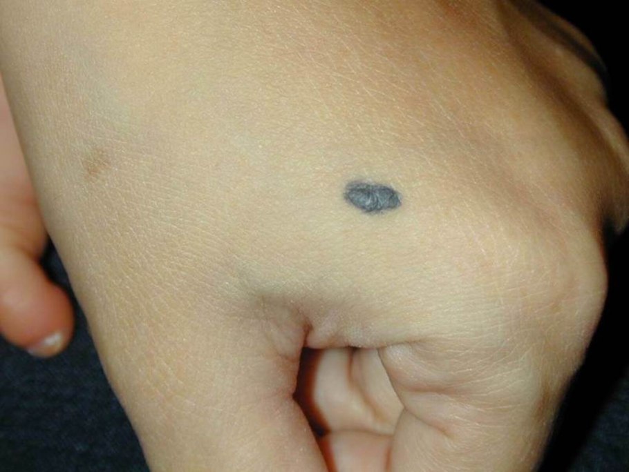 Бородавки (акрохорды) папилломы