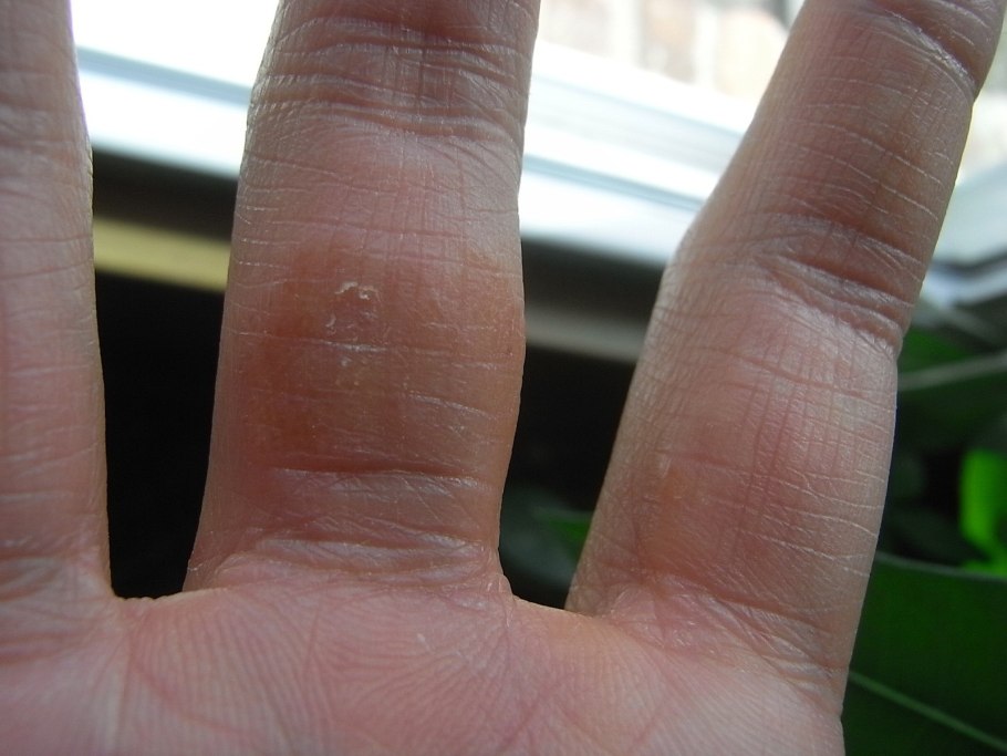 Обыкновенные бородавки