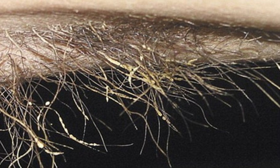 Кератома (себорейная бородавка)