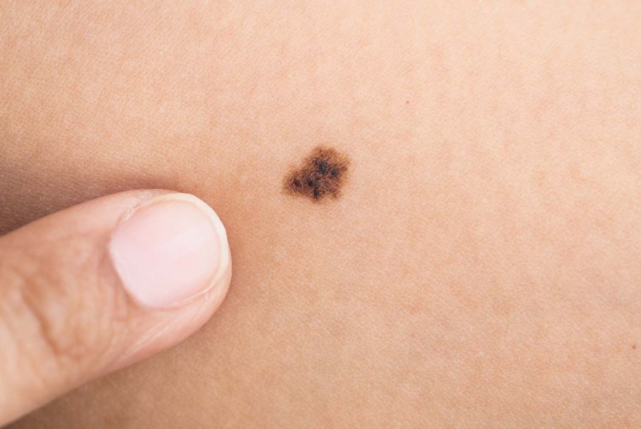 Нитевидные бородавки (акрохорды)