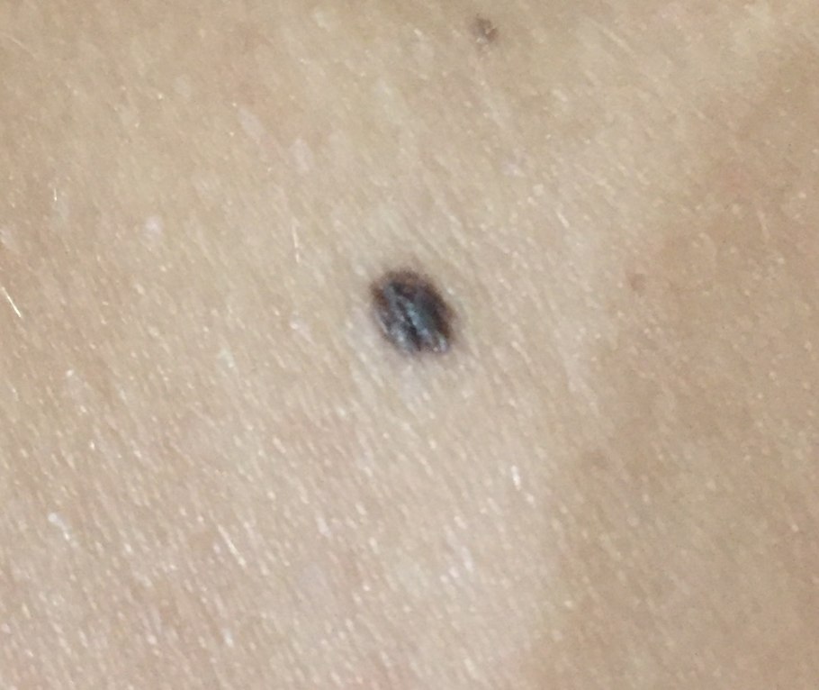 Строения папилломы Тип папилломы