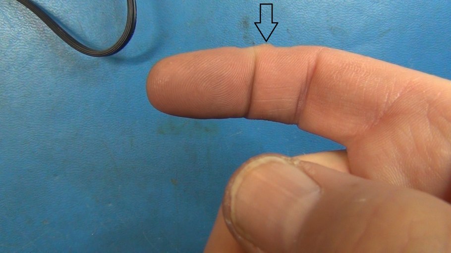 Лентигинозная меланома