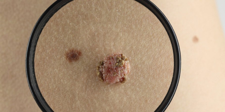 Меланома базалиома карцинома