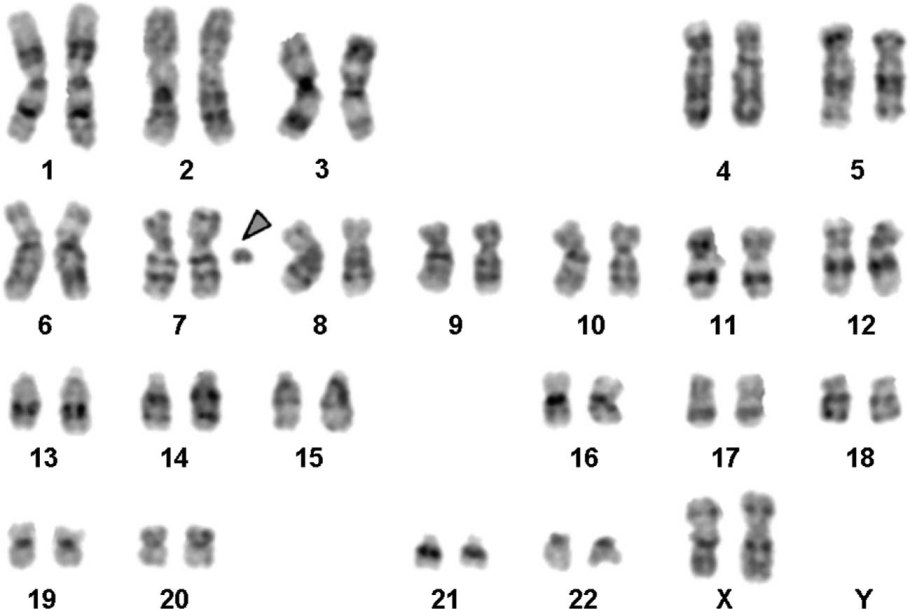 Кариотип при синдроме Вильямса