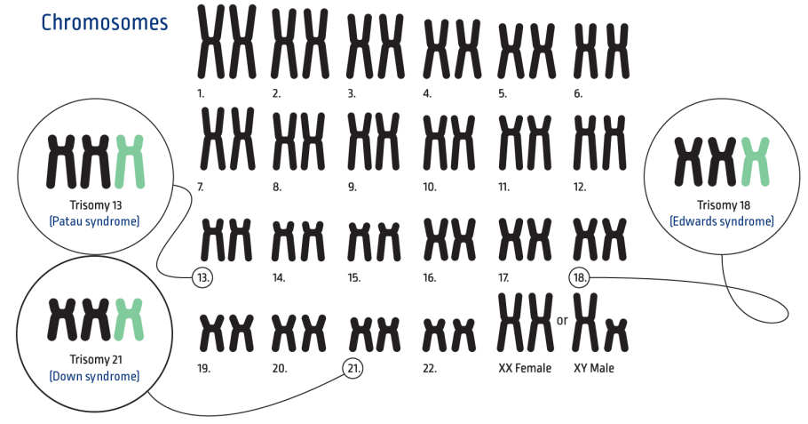 Синдром Дауна хромосомы