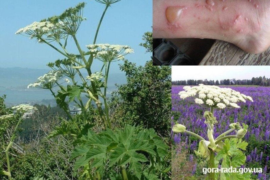 Борщевик Сосновский ожоги