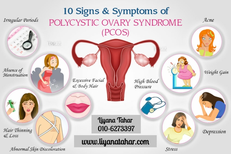 Синдром поликистозных яичников