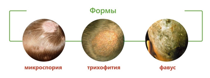 Фавус парша