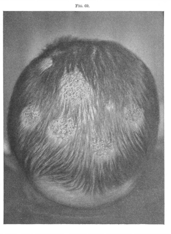 Фавус парша