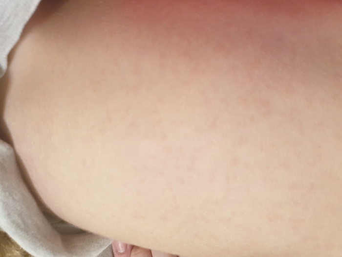 Сыпь на теле ребенка