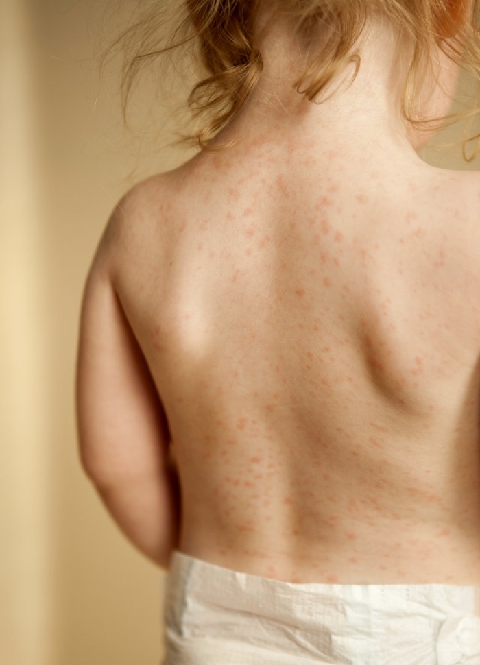 Потница на спине у ребенка