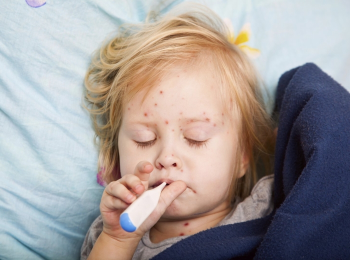 Ветрянка у детей