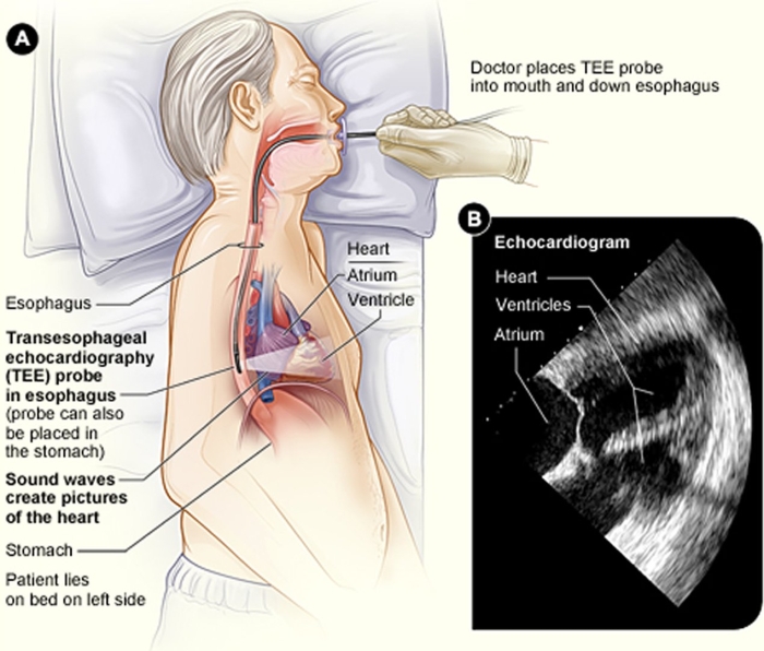 Transesophageal echocardiogram
