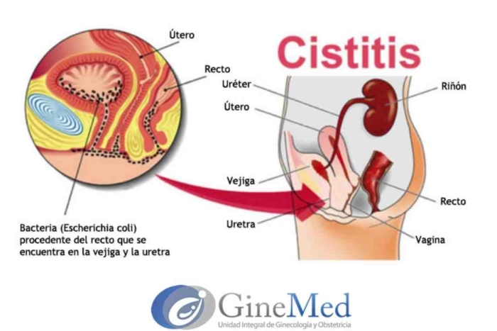 Посткоитальный цистит