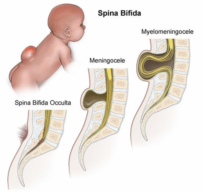 Spina bifida (расщепление позвоночника)