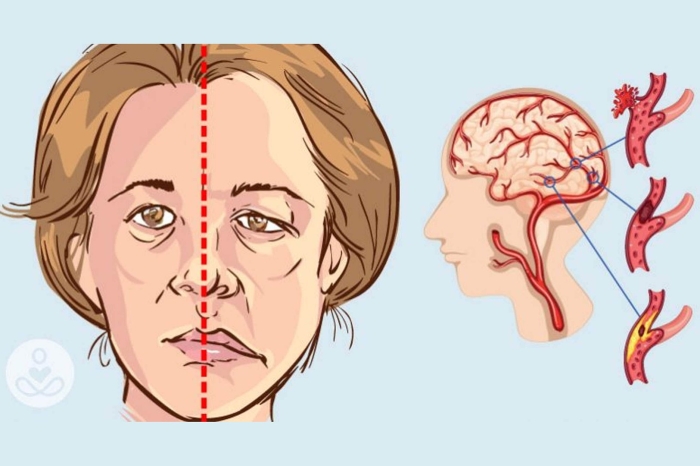 Ишемический инсульт лицо