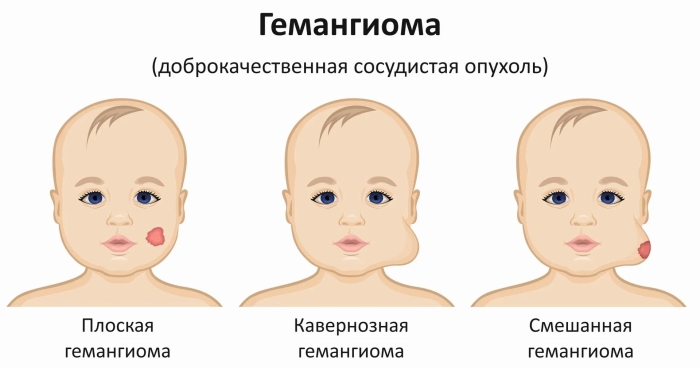 Гемангиома у новорожденного